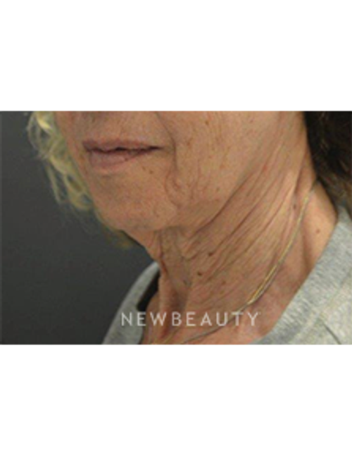 Dr. B. Aviva Preminger - Neck Lift - Before