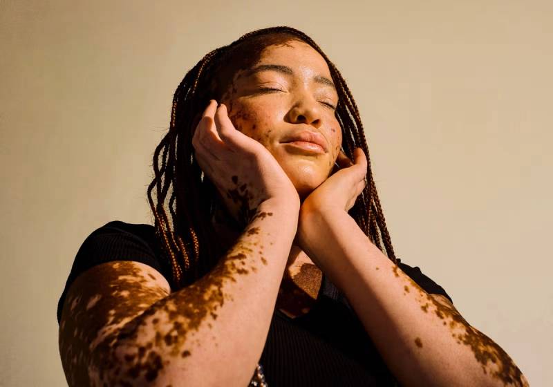 Vitiligo