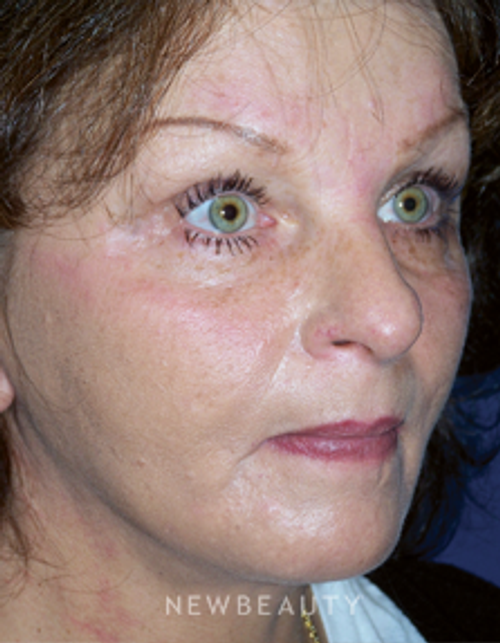 Dr. Adam Summers - SMART FACELIFT™ - After