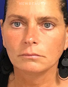 Dr. Dilip Madnani – Facelift & Necklift - After