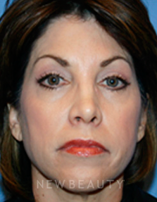 Dr. Kelly Bomer Liquid Facelift - Before