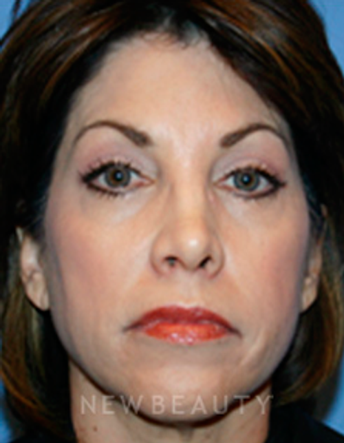 Dr. Kelly Bomer Liquid Facelift - Before