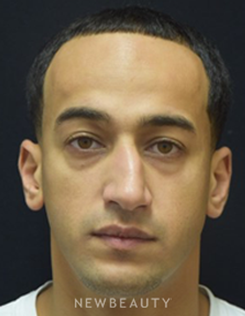 Dr. Jeffrey B. Wise - Rhinoplasty - Before