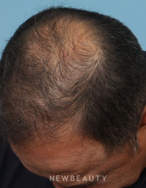 Dr. Kathleen Behr - Hair Loss Treatment - Before