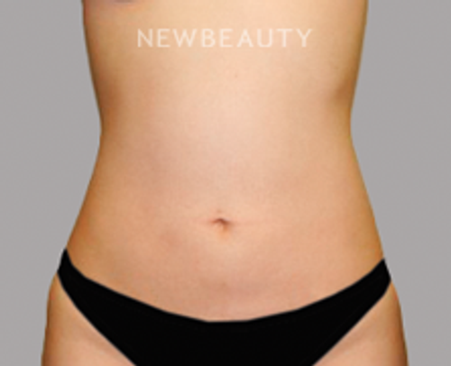 Dr. Sanjay Grover - Liposuction - 49728211 - After