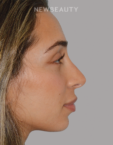 Dr. Anthony Bared - Rhinoplasty - 46164855 - After