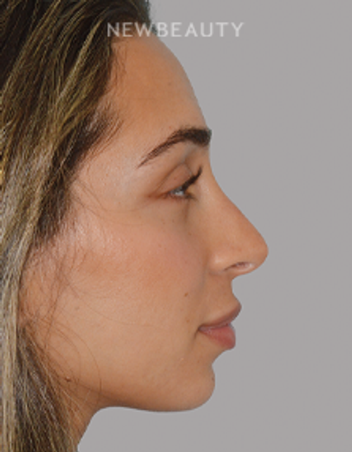 Dr. Anthony Bared - Rhinoplasty - 46164855 - After