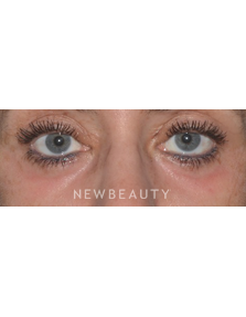 Dr. Roman Rayham - Blepharoplasties - After