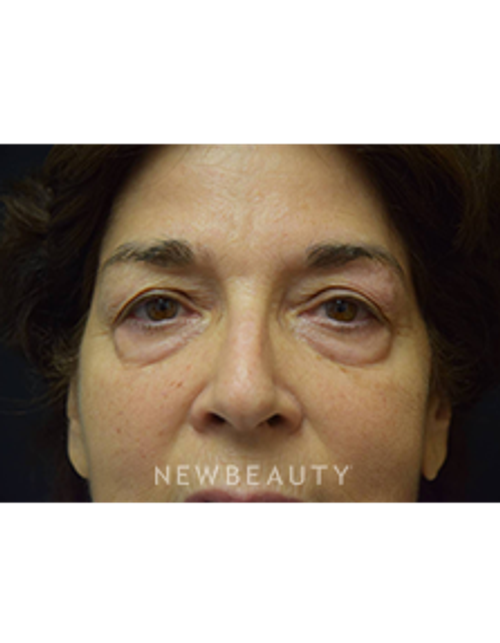 Dr. Jeffrey B. Wise - Eyelift, Facelift & Lasers - Before