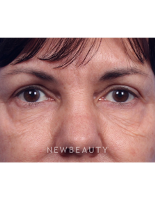 Dr. Kelly Bomer - Liquid Facelift - Before