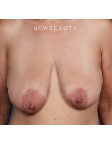 Dr. Chet Mays - Breast Lift - Before
