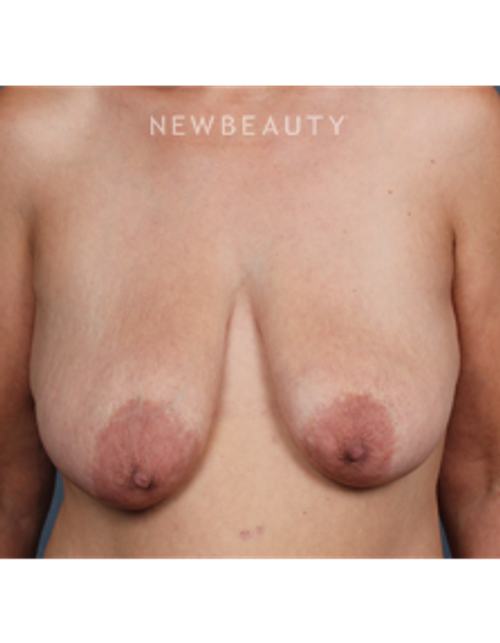 Dr. Chet Mays - Breast Lift - Before