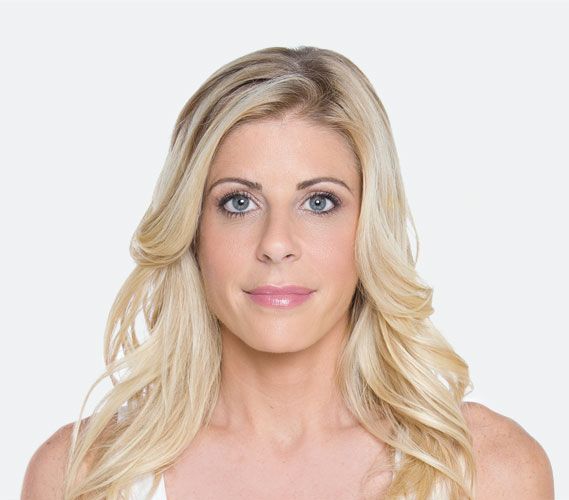 After liquid facelift