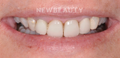 Dr. Salvator La Mastra - Smile Makeover - 46106865 - Before