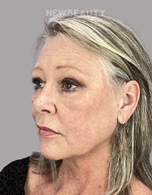 Dr. Sheila Barbarino-Blepharoplasty-54799251 - After