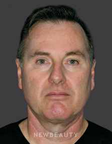 Dr. Mary Herte Eyelift, Injectables & Fillers - After