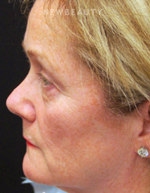 Dr. Mokhtar Asaadi Facelift - Before