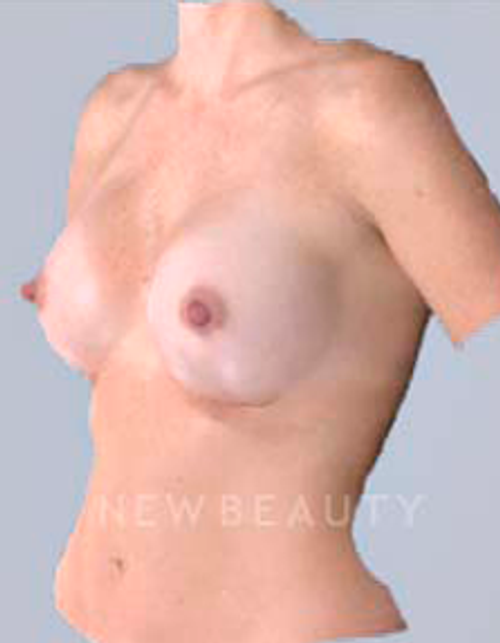 Dr. Bradley Bengtson Simulated Implants - After