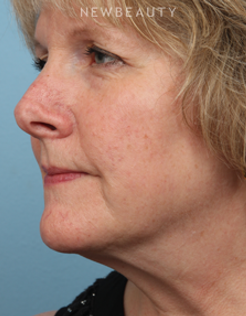 Dr. Kathleen Behr - CoolSculpting - After