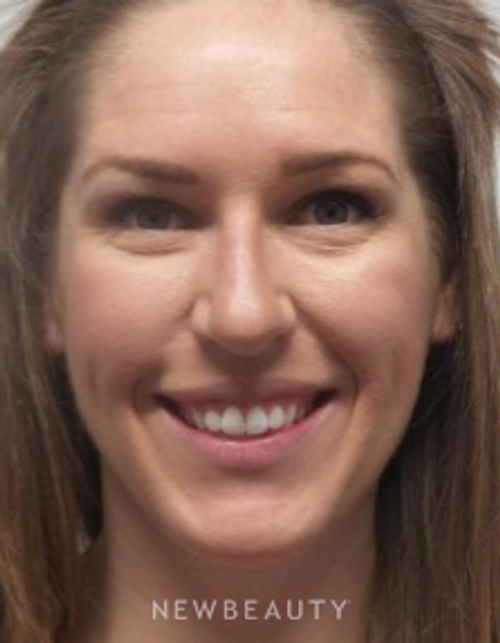 Dr. Marina Peredo - Botox - After