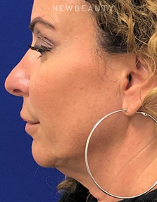 Dr. Dilip Madnani - Facial Rejuvenation - Before