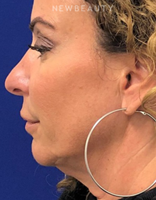 Dr. Dilip Madnani - Facial Rejuvenation - Before