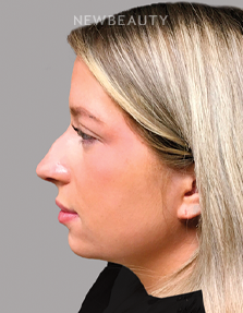 Dr. Dilip Madnani - Facelift -  45284120 - After