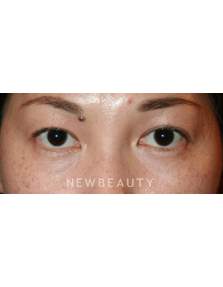 Dr. John Kang - Eyelift - Before
