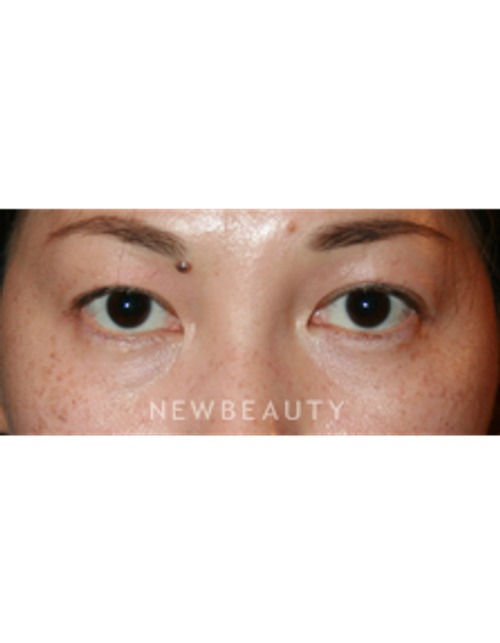 Dr. John Kang - Eyelift - Before