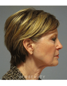 Dr. Mentz - Eyelift, Facelift, Necklift - Before