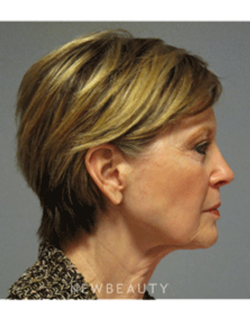 Dr. Mentz - Eyelift, Facelift, Necklift - Before