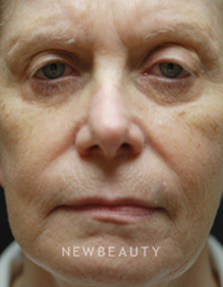 Dr. Kenneth Beer Lumines, Laser - Before