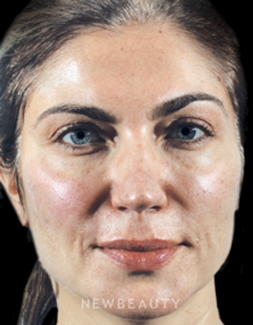 Dr. Marina Peredo - Lip Filler and Cheek Augmentation - After