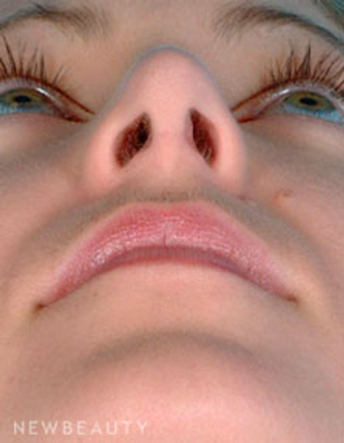 Dr. David Kim Rhinoplasty - After