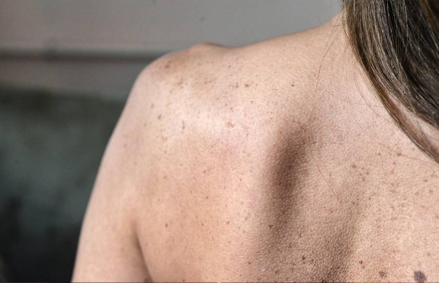 skin cancer