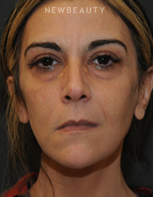 Dr. Janet Allenby - Liquid Rejuvenation - Before