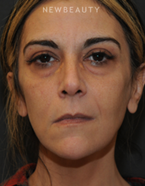 Dr. Janet Allenby - Liquid Rejuvenation - Before