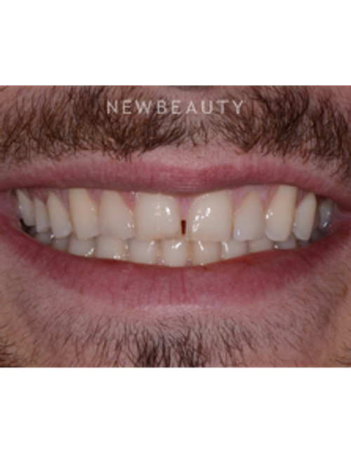 Dr. Irene Grafman - Dental Bonging - Before