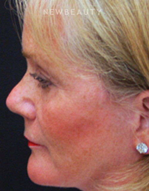 Dr. Mokhtar Asaadi Facelift - After