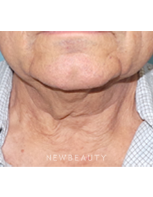 Dr. Sean Simon - Precision Neck Lift - Before