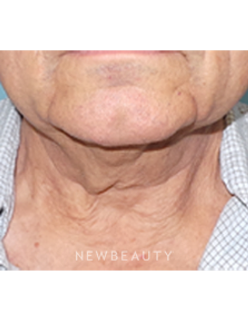 Dr. Sean Simon - Precision Neck Lift - Before