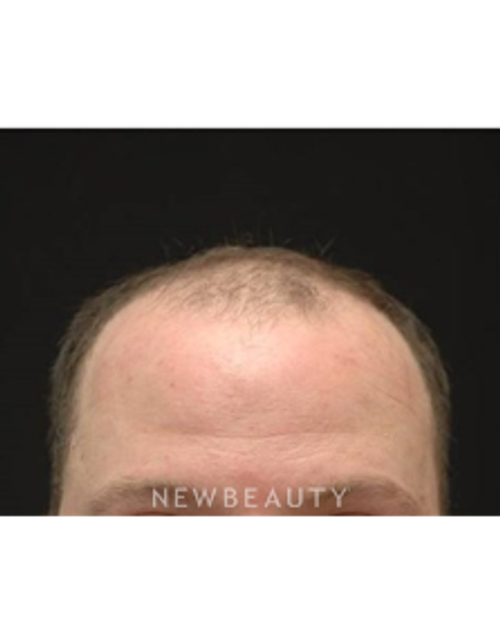 Dr. Jeffrey B. Wise - Hair Transplant - Before