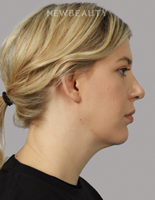 Dr. Michael McNeel - Profile Refinement - 44726153 - After