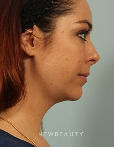 Dr. Kenneth Beer - Kybella - Before