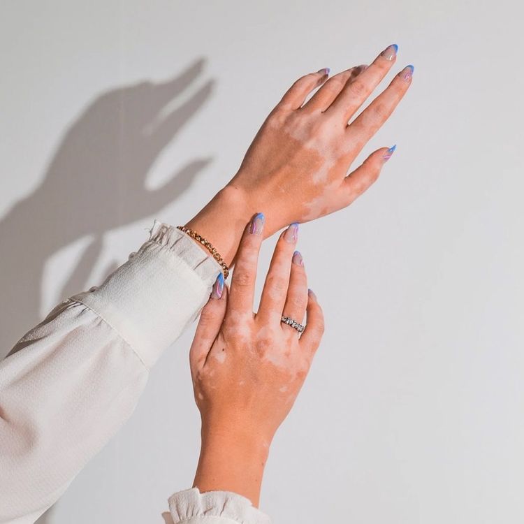 Vitiligo Repigmentation