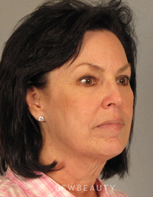 Dr. Mentz, Facelift & Necklift - Before