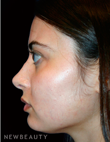 Dr. Kelly Bomer Rhinoplasty - After
