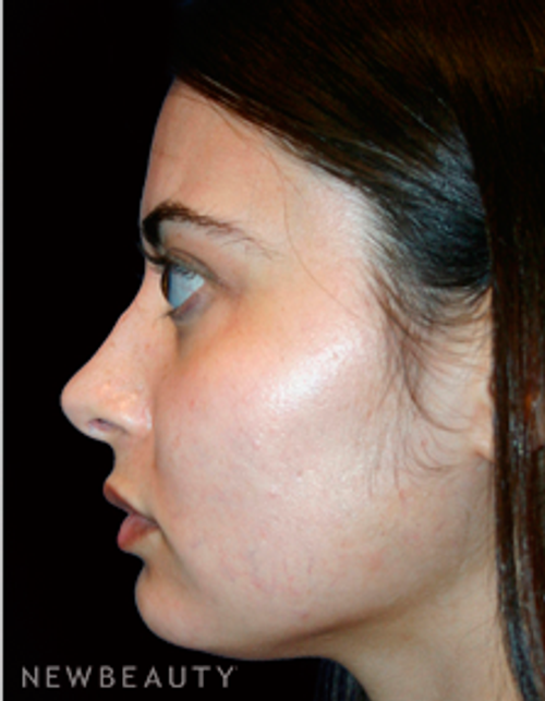 Dr. Kelly Bomer Rhinoplasty - After