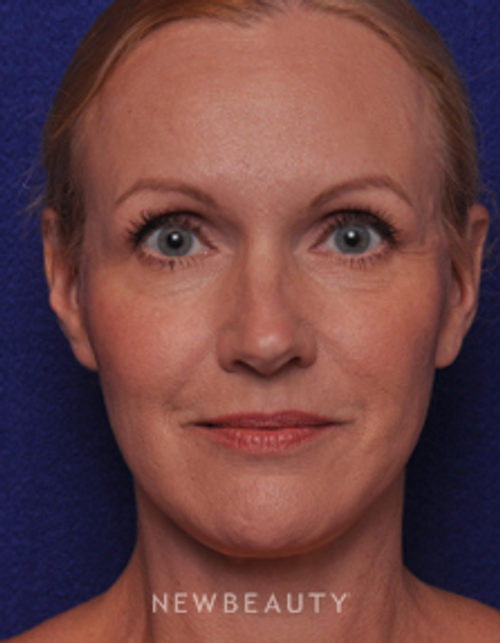 Dr. Alan Durkin - Blepharoplasties - Before