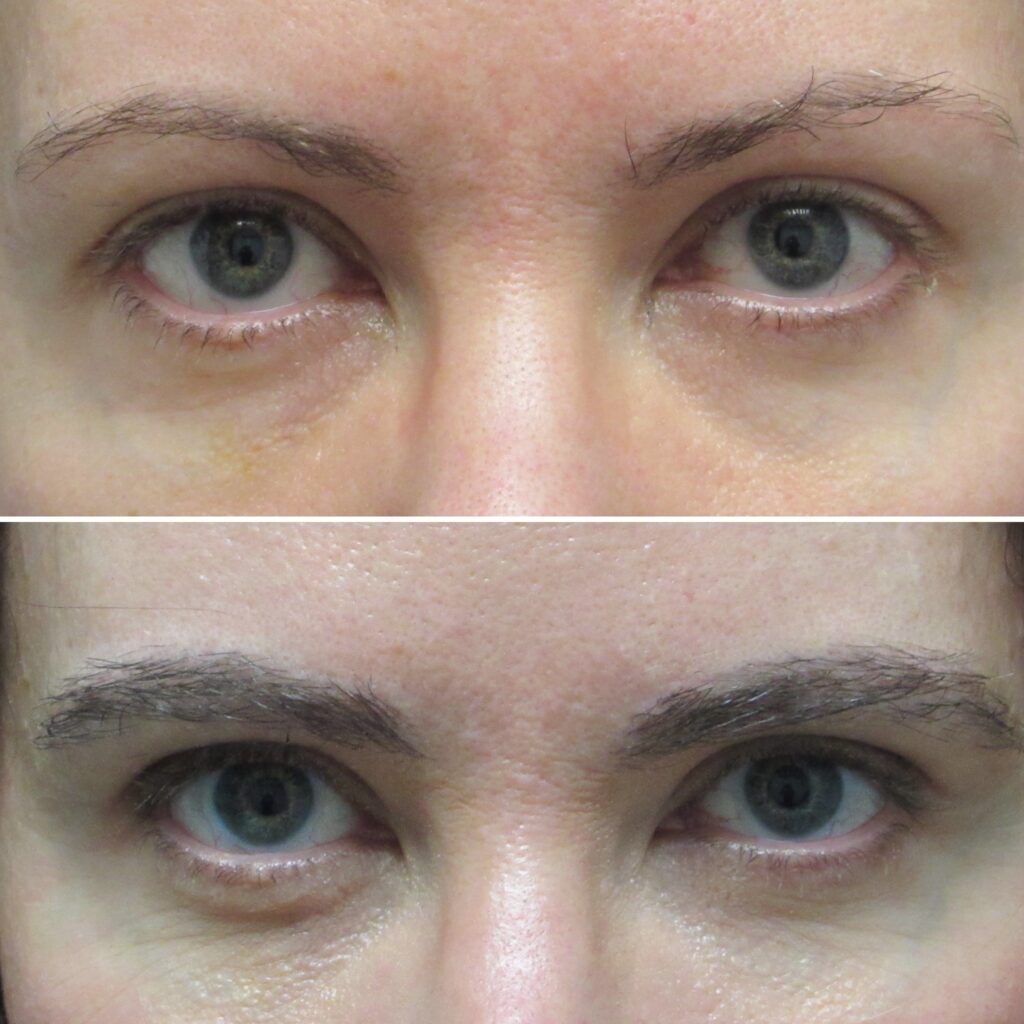 NewBeauty’s Real Patient Stories, Eyebrow Transplant